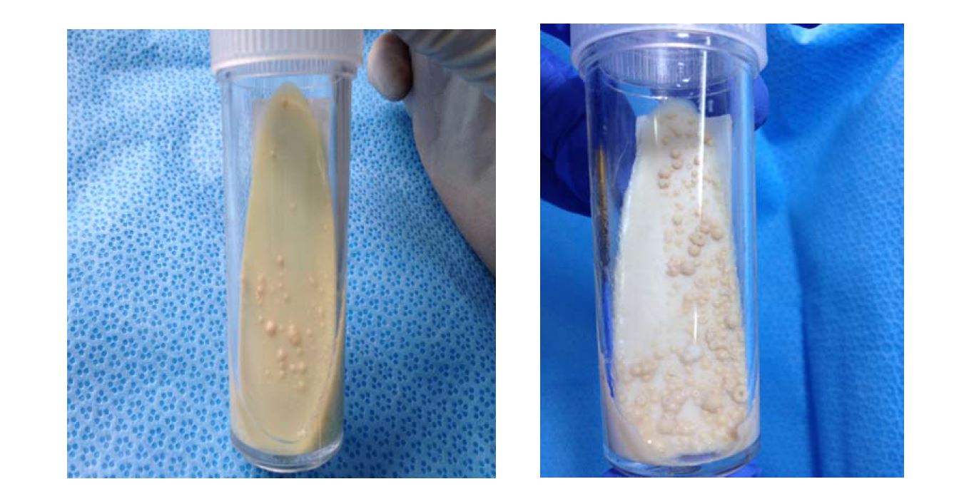 Morphology of positive samples and results of PCR. These colonies were identified NTM by primary PCR and M. intracellulare by third PCR