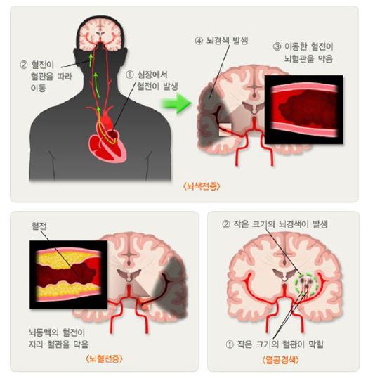그림 205. 허혈성 뇌졸중 (출처: 보건복지부, 대한의학회)