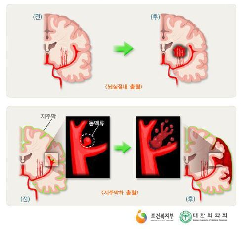 그림 207. 출혈성 뇌졸중 (출처: 보건복지부, 대한의학회)