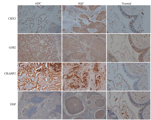 Expression of CBX3,GJB2, CRABP2 and DSP proteins in tumor tissues from NSCLC patients using immunohistochemistry
