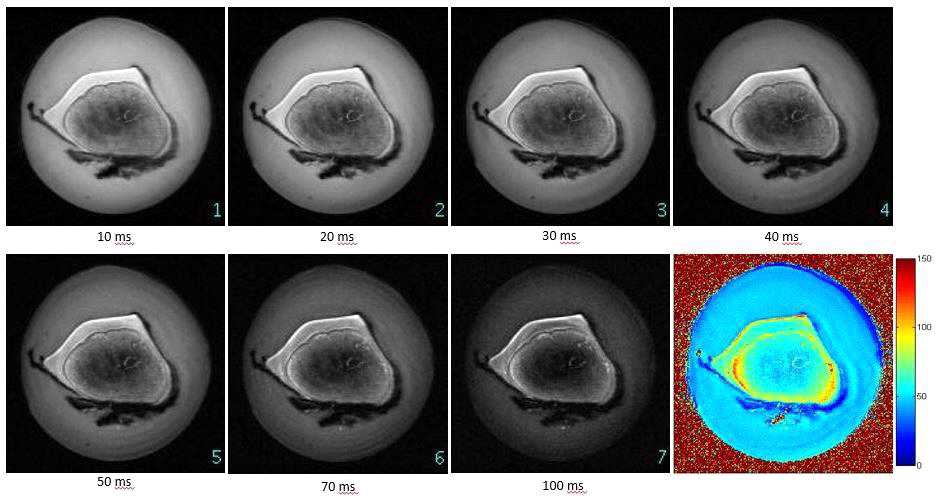 T1rho MRI 기법을 이용하여 5개의 스핀락킹 시간(10, 20, 30, 40, 50, 70 ,100 ms)에서 얻어진 MRI 영상과 이들 결과로부터 산출된 T1rho map (오른쪽 아래).