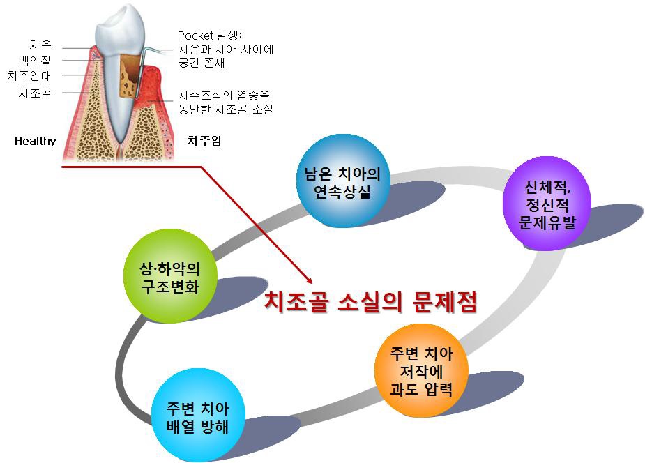 치조골 손실의 문제점