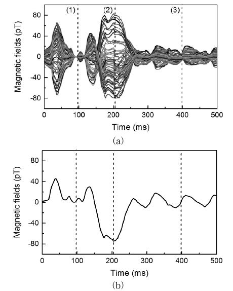 Measured magnetic fields by 64-channel MCG system (a) and a representative MCG channel (b) toward acute myocardial ischemia generated from lateral sub-epicardium.