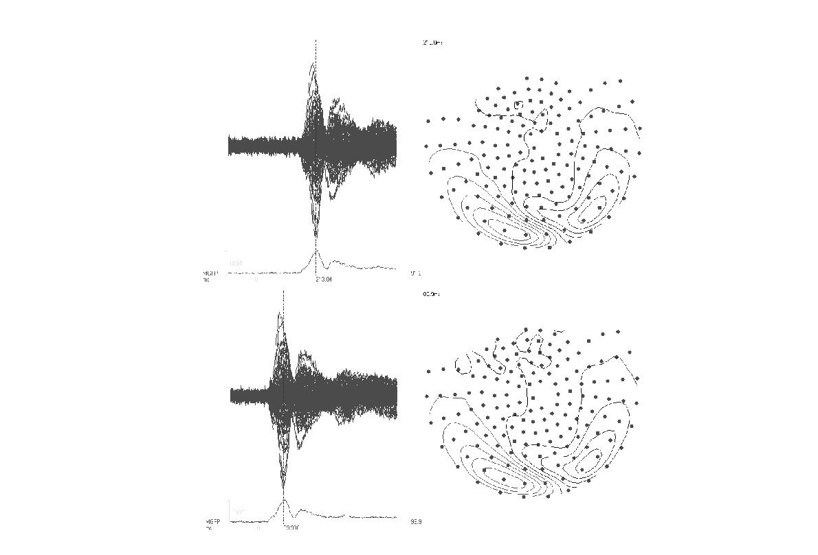 Averaged evoked magnetic fields in response to visual stimuli when the triggering time is not synchronized (a) and synchronized by photosensor (b).