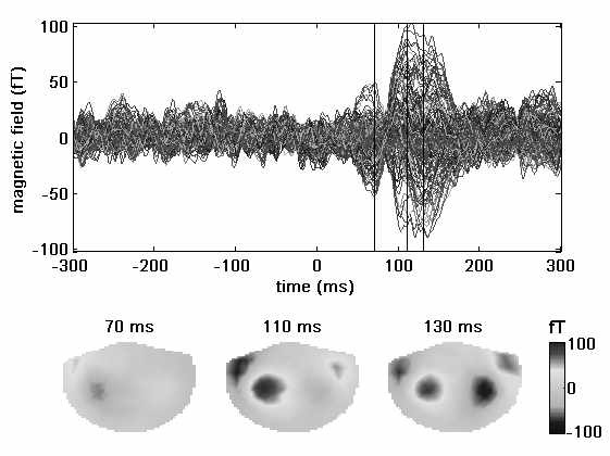 The real auditory evoked MEG data from a subject. The averaged auditory evoked magnetic fields at all MEG sensors are displayed as a butterfly plots(top) with topographic maps at three time points(bottom). The solid vertical lines denote corresponding time points[53].