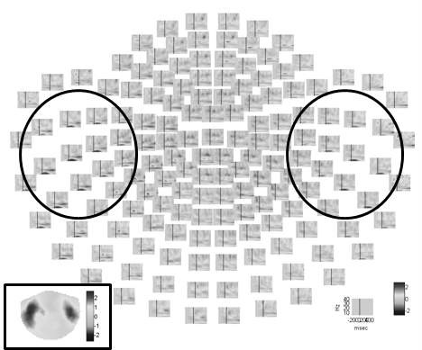 The Event related spectral perturbation（ERSP）obtained from the auditory evoked field reconstructed for tangential magnetometer sensors. ERSP of all sensors are displayed at the locations of each sensor (5-40 Hz, -300~500 ms). The inlet shows the ERSP map at 8 Hz averaged between 50 ms and 150 ms.