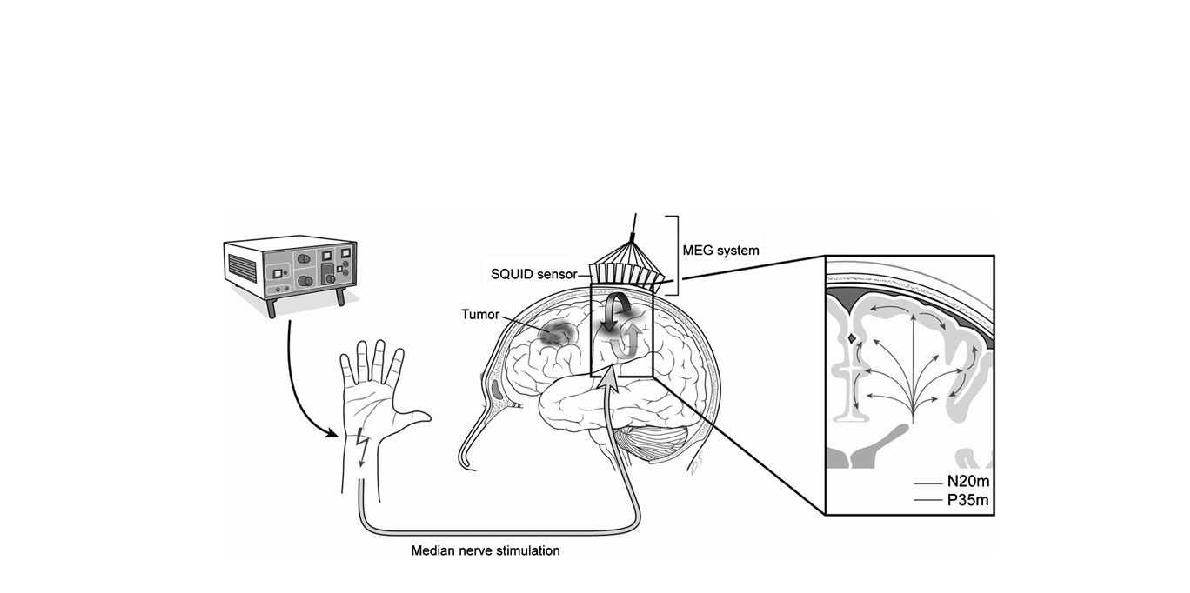 Schematic diagram of the sensory evoked magnetic field using the median nerve stimulation