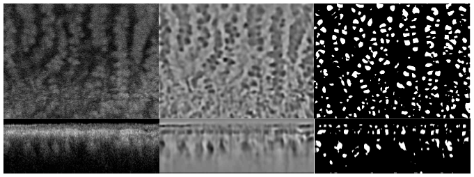 3차원LoG 기반의 watershed transform을 처리한 결과의 일부로 단층 영상과 en-face 영상에서 모두 경계가 구분된 binary 영상으로 구현된 결과, (좌)motion artifact가 제거된 3차원 OCT 영상, (우)경계가 구분된 binary 영상