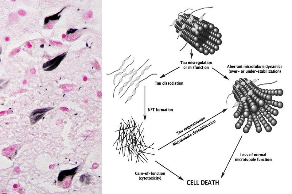 (A) Alzheimer's diseased brain에 존재하는 Neurofibrillary tangle (B) 타우 단백질에 의한 세포 사멸의 경로