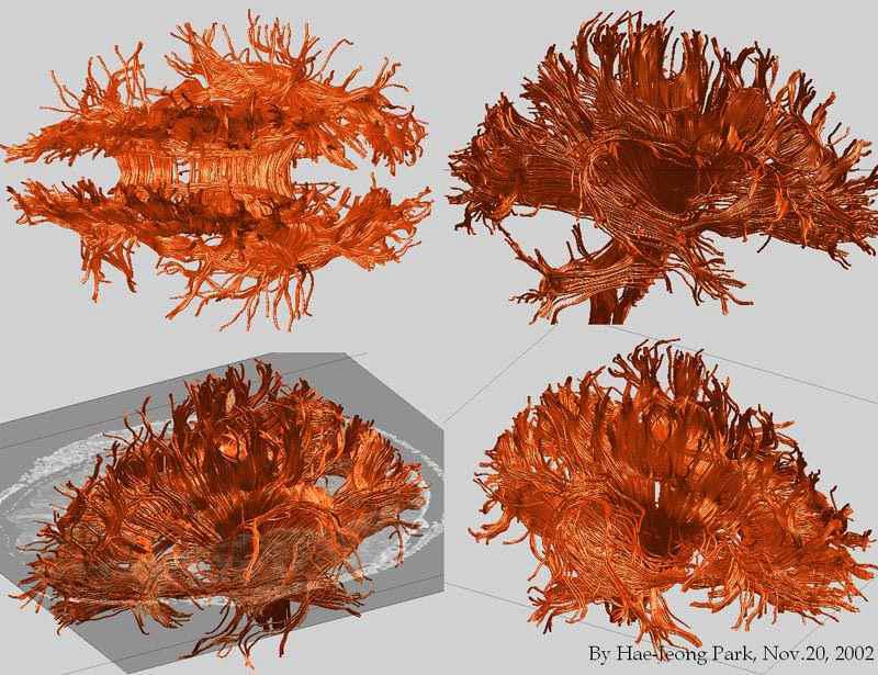 3T MRI의 확산텐서 영상을 통한 뇌 신경섬유 분포