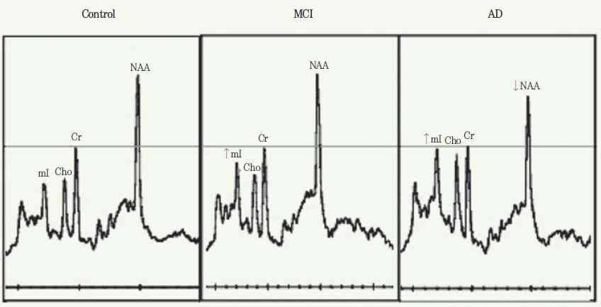 일반인 MCI 환자 및 AD 환자의 MR 스펙트럼 비교