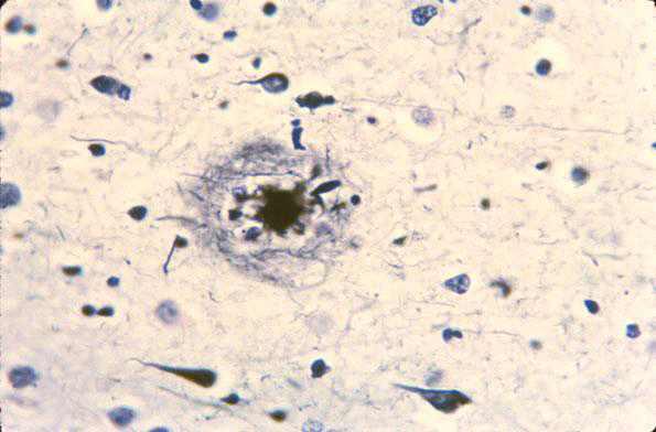 Pathology of Alzheimer’s Disease. Neuritic plaques(beta amyloid protein) and neurofibrillary tangles (tau protein)