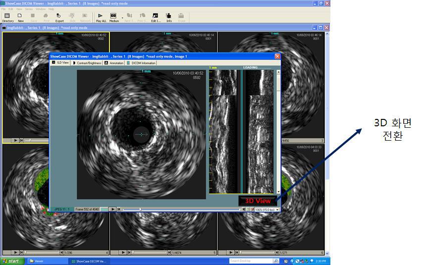 2D IVUS 화면 example