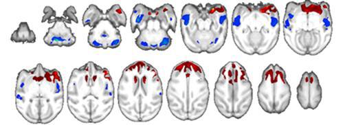 MPTP를 이용한 파킨슨 병 영장류모델에서 T1-weighted images를 분석한 결과 특정 뇌영역(insula, temporal gyrus, cerebellum)의 회백질 부피가 감소