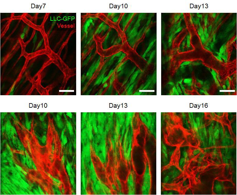 암세포 주변부 및 가장자리의 angiogenesis 관찰 결과.