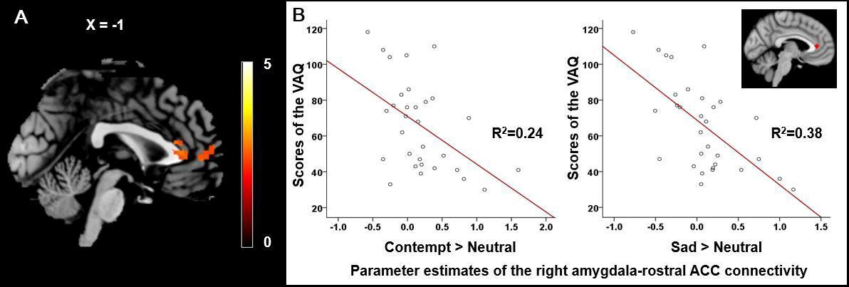 (A) 언어폭력의 정도와 부정적 얼굴감정 처리 동안 우측 편도체와 기능적 연결 영역 사이에 음의 상관관계를 가지는 뇌영역. (B) 언어폭력과 경멸(좌), 슬픔(우) 얼굴에 따른 우측 편도와 부리측 전측대상회 연결성 사이의 관련성 회귀 그래프