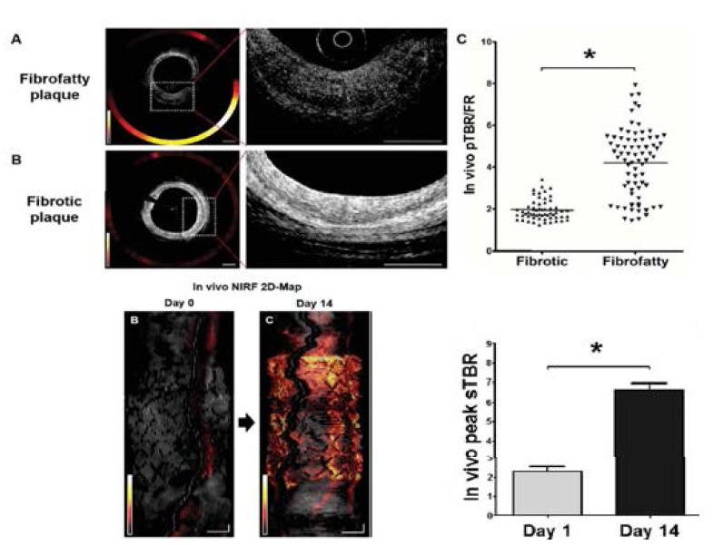 Fibrofatty plaque 및 DES 스텐트 주입후 14일에 강한 NIRF 신호의 증가를 보이는 모습