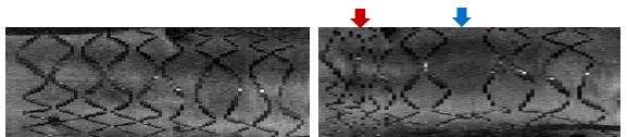 돼지 관상동맥의 stent 구간 en face OFDI 이미지