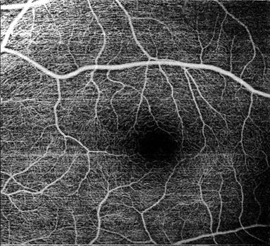 망막 혈관 영상