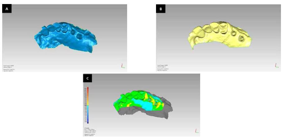 Scanned data was used intraoal scanner