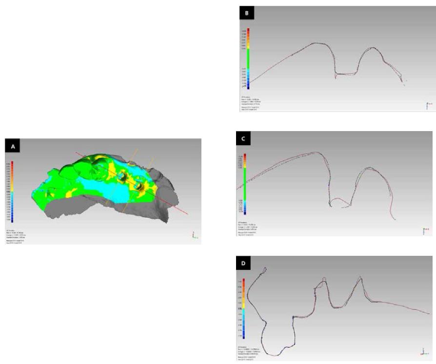 Analysis of difference between the two virtual models (Customized healing abutment used / final abutment used).