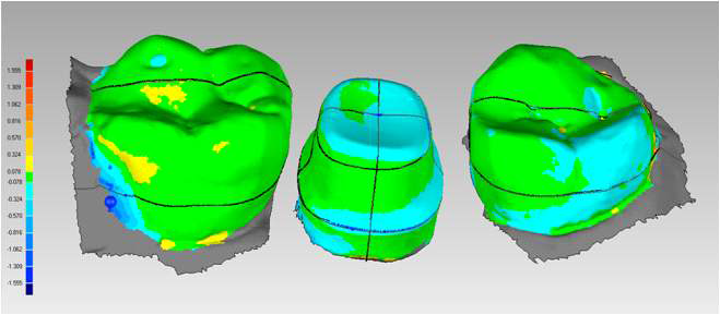 Superimposed image of two scan images: transfer type impression using Impression healing Abutment and pick-up type impression using impression coping.