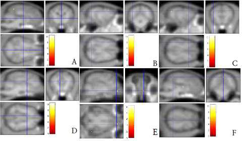 비검역물과 비교했을 때 검역물에서 더 높은 활성화 신호를 나타내는 부위의 fMRI영상.