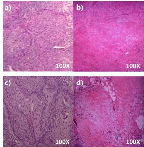 자궁경부암 환자로부터 적출한 암조직과 PDOX 모델로부터 적출한 암조직의 조직병리학적 특성 비교