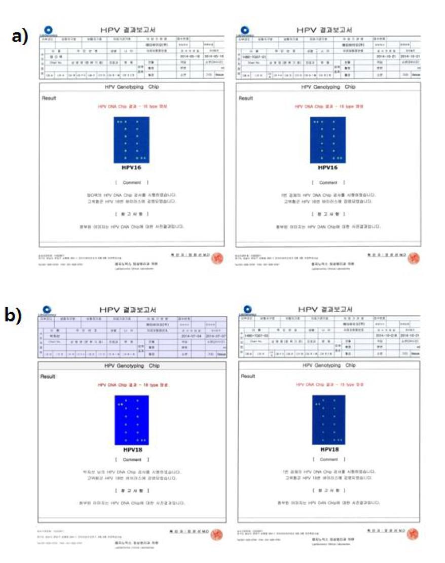 자궁경부암 환자로부터 적출한 암조직과 PDOX 모델로부터 적출한 암조직의 HPV type의 비교. a) 1480-TG07-01, b) 1480-TG07-03.