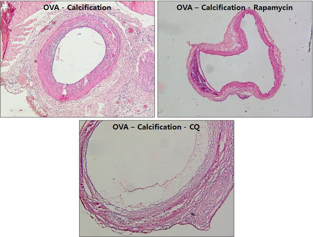 OVA-암컷 랫드 혹은 수컷 랫드에게 calcification 유도 수술을 시행 한 후, 각각 vehicle, chloroquine (CQ), Rapamycin (Rapa) treatment group으로 각각 나누어 복강 투여 한 후 2주 후에 채취한 혈관의 H&E stain 소견