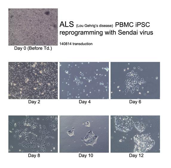 ALS 질환자 말초혈액으로부터 sendai viral system을 이용하여 제작한 역분화줄기세포