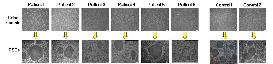 수립한 환자 및 정상인 소변세포 유래 역분화줄기세포주