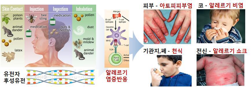 알레르기질환의 다양한 발병 요인