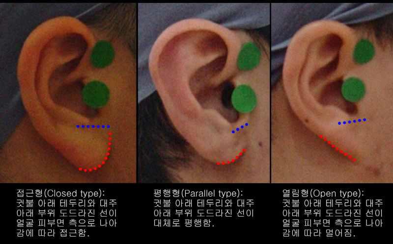 귓불과 얼굴 피부면의 부착상태 분류기준 및 참고 그림