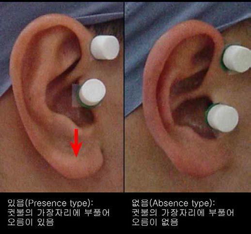 귓불의 가장자리 형태 분류기준 및 참고 그림