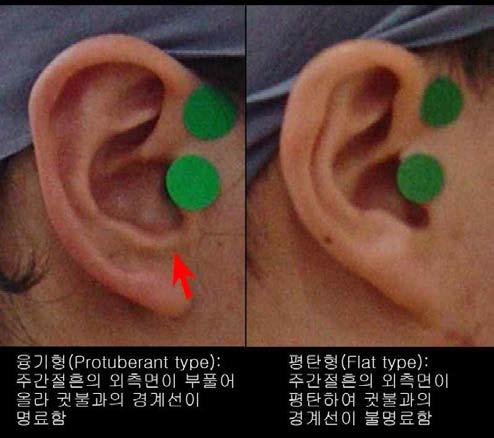 주간절흔 외측면 형태 분류기준 및 참고 그림