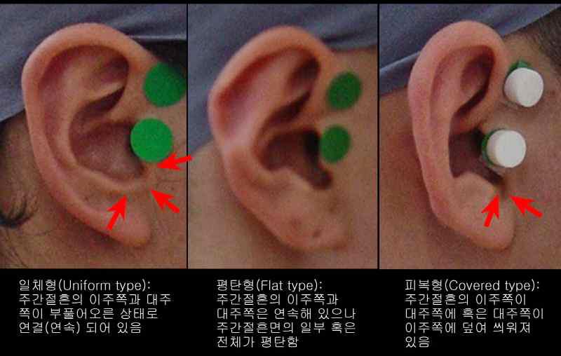 주간절흔 연결 형태 분류기준 및 참고 그림