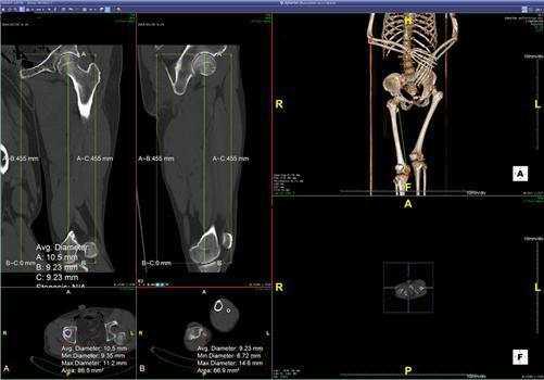 CT를 이용한 넙다리뼈 길이의 측정