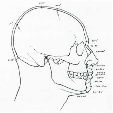 얼굴뼈와 피부표면 사이의 해부학적 표지점 좌표의 불일치(George 1993)