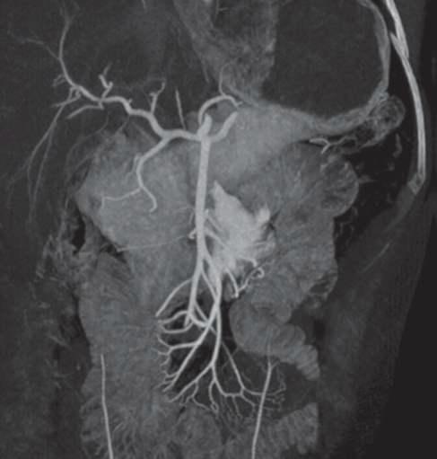 Superior mesenteric artery에서 혈관외 조영제 누출이 보이고, 췌장 실질의 조영되고 있다.