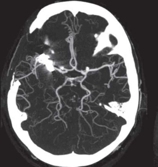지용성 조영제 사용 CT 영상. 우측 내측 대뇌동맥 M1 분절에 클립을 삽입하였다. 대뇌동맥은 매우 뚜렷하게 보이지만 대뇌실질은 조영되지 않는다.