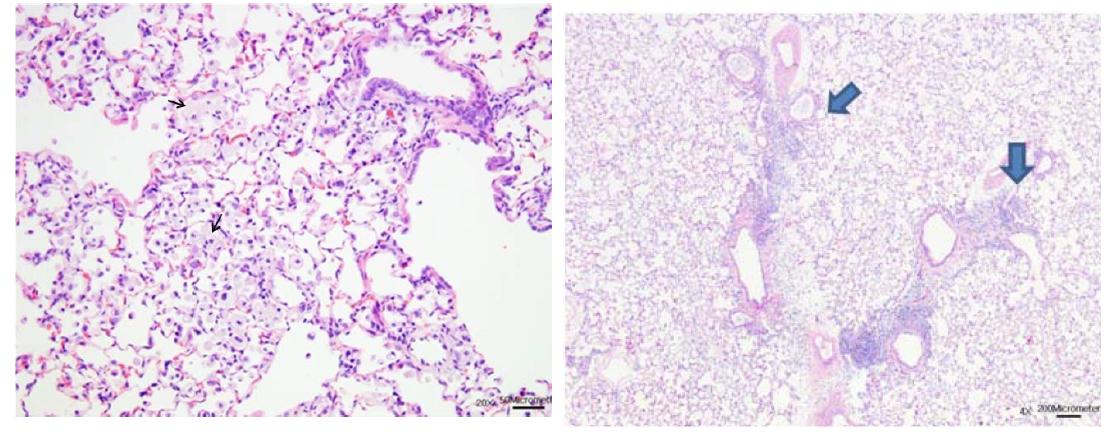 PHMG 노출군에서 관찰된 공포상 대식세포(Foamy histiocytes, 좌) 섬유증 (Fibrosis)