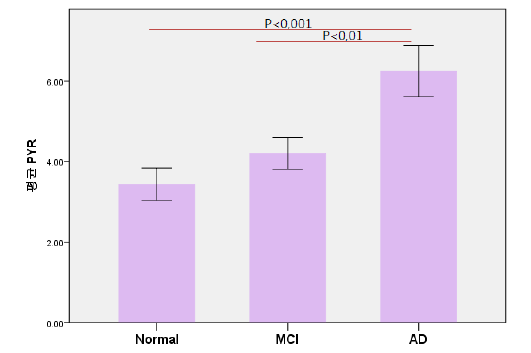 치매의 정도(normal = 17명, MCI 경도인지장애 = 29명, AD 알츠하이머 치매 = 30명)에 따른 혈중 pyruvate (PYR) 농도