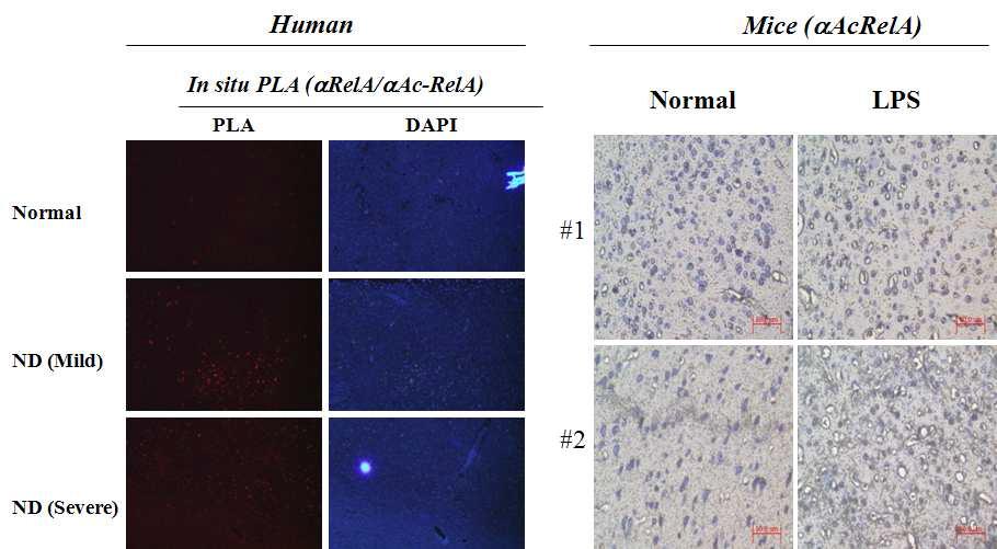 뇌질환환자와 염증유도 동물에서의 NF-kB 아세틸화가 변화 검토
