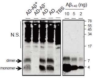 알츠하이머 질환자의 사후 뇌에서 Aβ oligomer의 확인