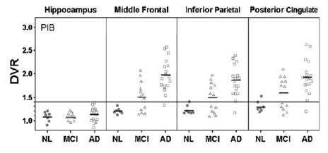 Scatter plots showing regional PIB binding from the ROI analysis in the hippocampus, MFG, IP, and PPC in subjects with NL, MCI, and AD