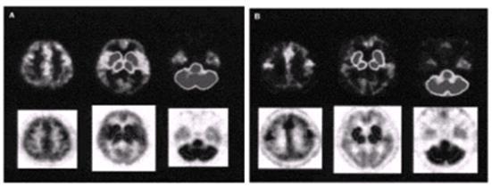 PET brain images of the radioactivity distribution in brains obtained 20-40 min after injection of [11C]MP4A in a normal participants (upper in A) with AD (upper B), with region of interest outlined