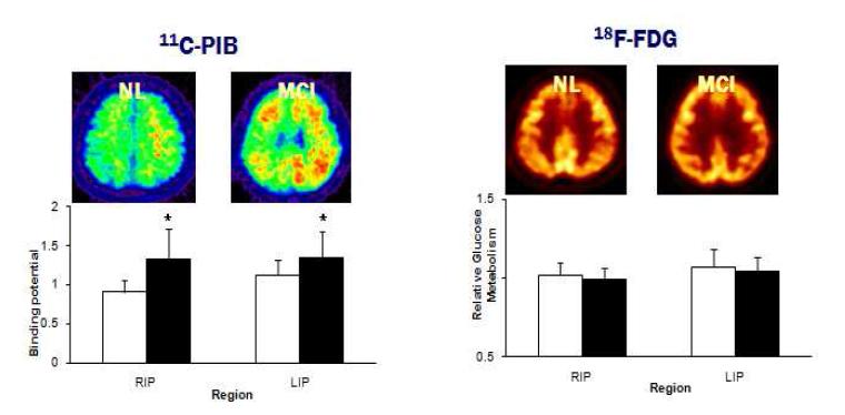 Comparison between NL and MCI of PIB binding potential and relative gluose metabolism in inferior parietal gyrus