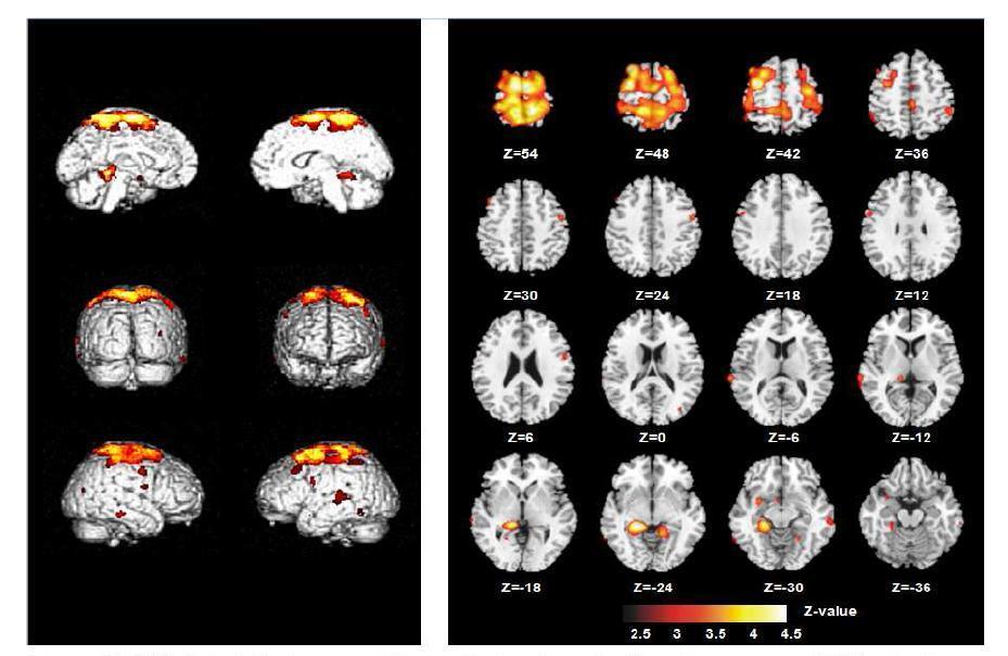 SPM (statistical parametric map) showing significant increase of PIB retention ratio in congnitively normal elderly with APOE ε4 carriers relative to with ε4 noncarrier