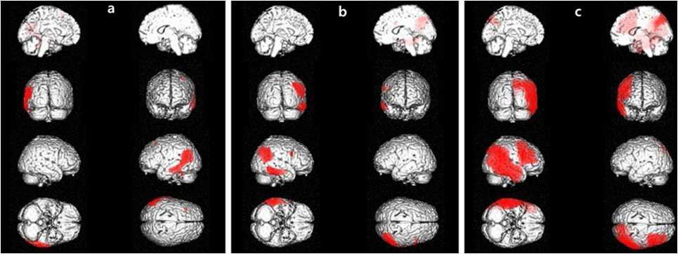 CLOX 와 국소 뇌 포도당대사 사이에 유의한 상관관계를 보이는 부위